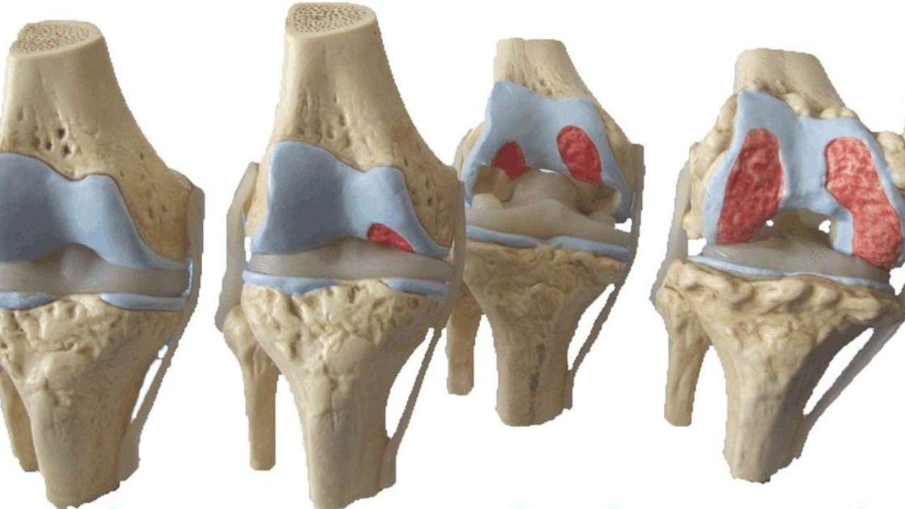 Preservação Articular do Joelho
